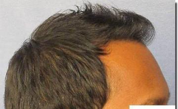 Hair restoration procedure results