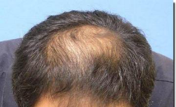 Hair restoration procedure results