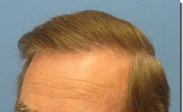 Hair restoration procedure results