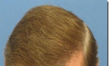 Hair restoration procedure results