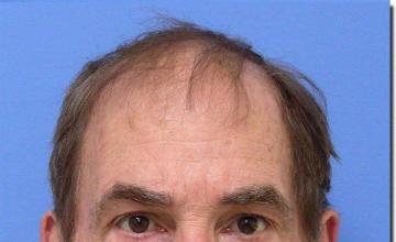 Hair restoration procedure results