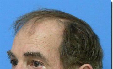 Hair restoration procedure results