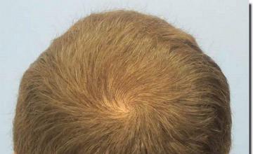 Hair restoration procedure results