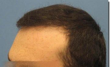 Hair restoration procedure results