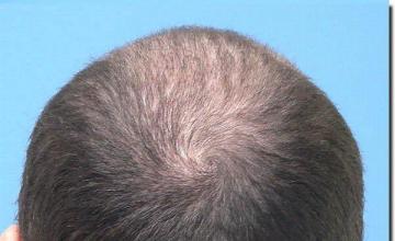 Hair restoration procedure results