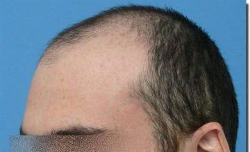 Hair restoration procedure results