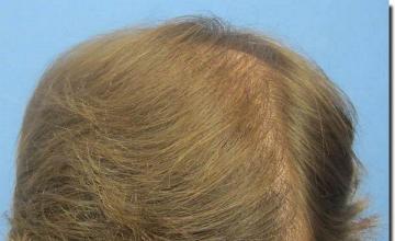 Hair restoration procedure results