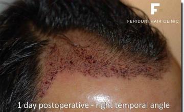 Hair restoration procedure results