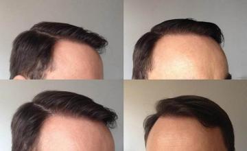 Hair restoration procedure before and after pictures