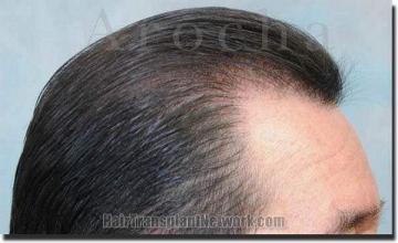 Hair restoration procedure results