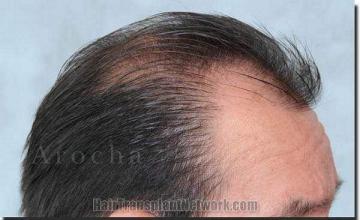 Hair restoration procedure results