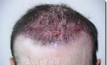 Hair restoration procedure results