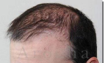 Hair restoration procedure results