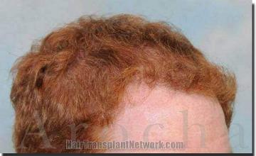 Hair restoration procedure results