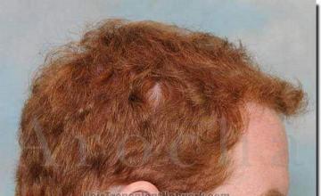 Hair restoration procedure results