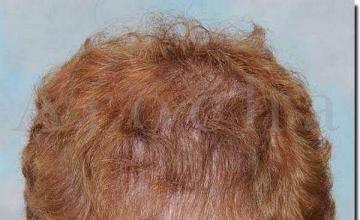 Hair restoration procedure results