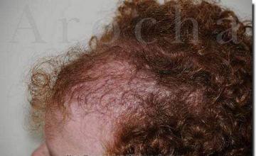 Hair restoration procedure results