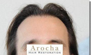 Hair restoration procedure results