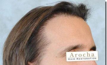 Hair restoration procedure results