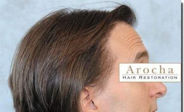 Hair restoration procedure results