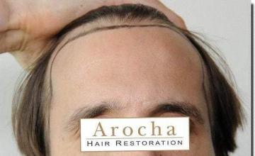 Hair restoration procedure results