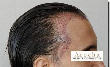 Hair restoration procedure results