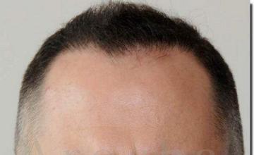 Hair restoration procedure results