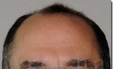 Hair restoration procedure results