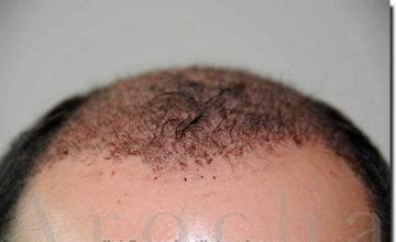 Hair restoration procedure results