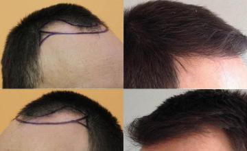 Hair transplantation surgery before and after pictures