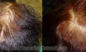 Crown view before and after hair restoration images