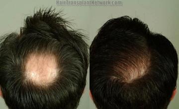 Hair transplantation procedure before and after photographs