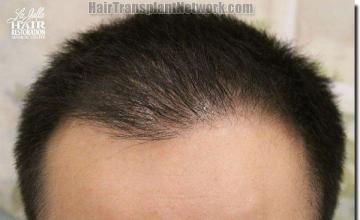 Hair restoration procedure results