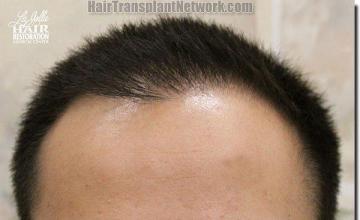 Hair restoration procedure results