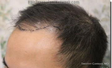 Hair restoration procedure results