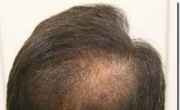 Hair restoration procedure results