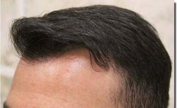 Hair restoration procedure results