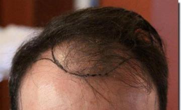 Hair restoration procedure results