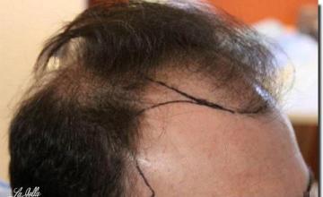 Hair restoration procedure results