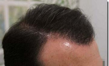 Hair restoration procedure results