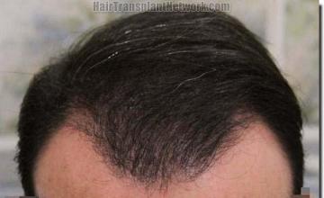 Hair restoration procedure results