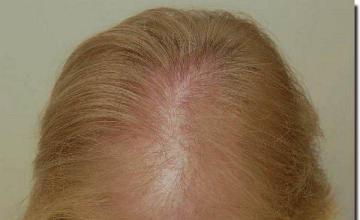 Hair restoration procedure results