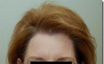 Hair restoration procedure results