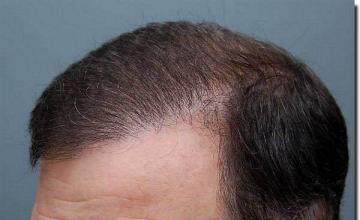 Hair restoration procedure results