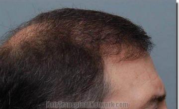 Hair restoration procedure results