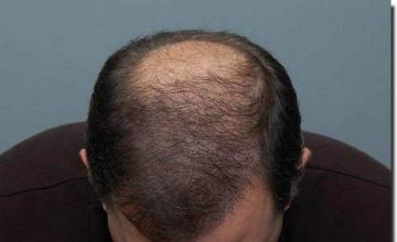 Hair restoration procedure results