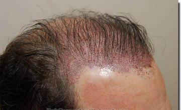 Hair restoration procedure results