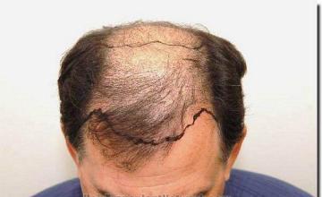 Hair restoration procedure results