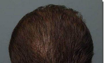 Hair restoration procedure results