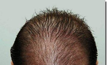 Hair restoration procedure results